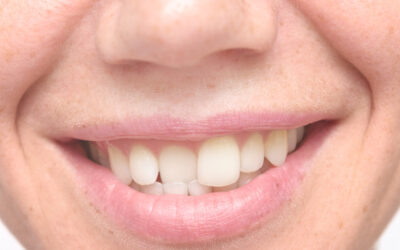 7 Major Reasons Why It’s Important To Fix Crooked Teeth