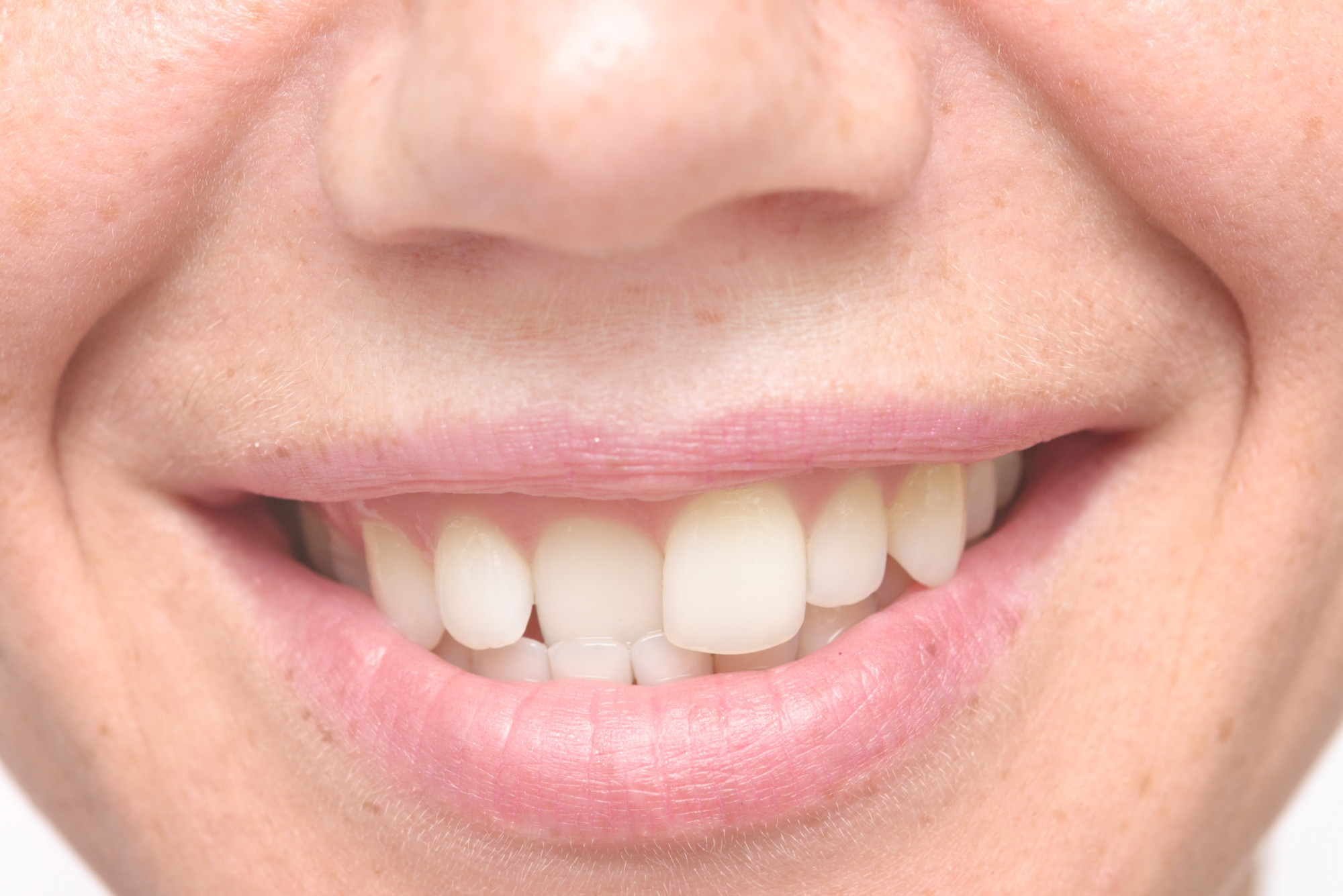 Orthodontics in fort mill sc