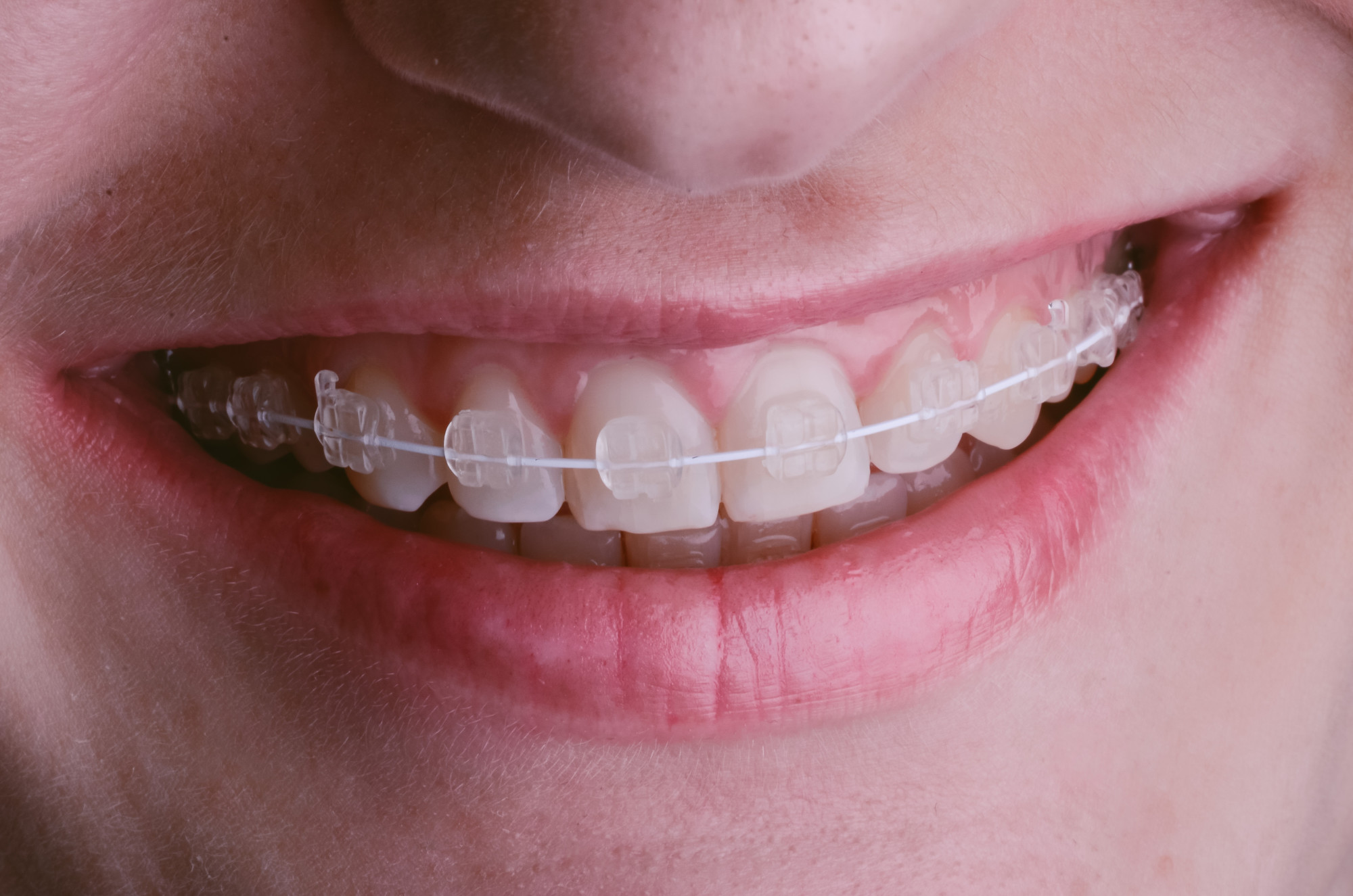Braces fort mill sc
