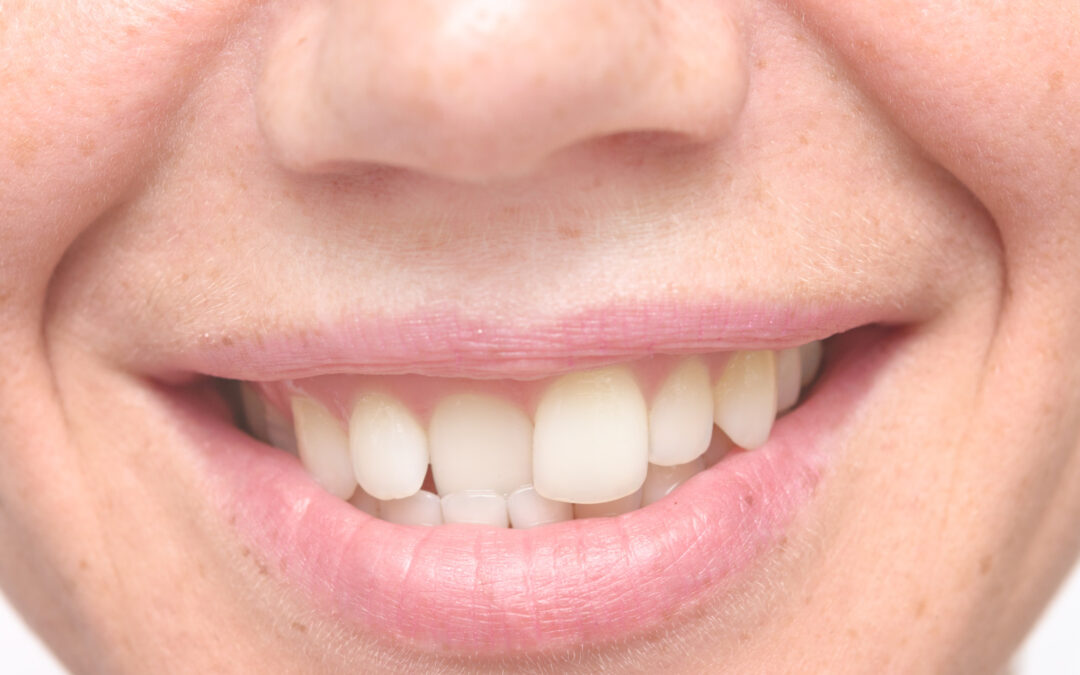 The Different Types Of Crooked Teeth, Explained