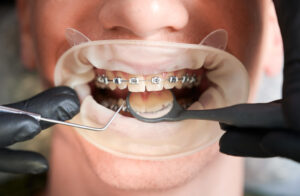 Orthodontist in Charlotte